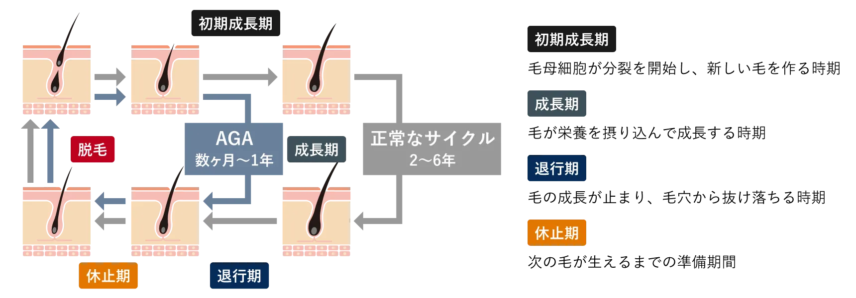 男性型脱毛症(AGA)の原因