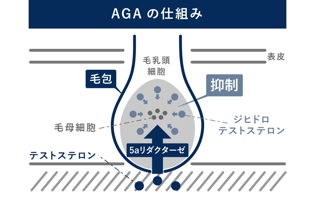 男性型脱毛症(AGA)は遺伝する