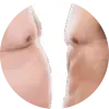 医療痩身プログラム