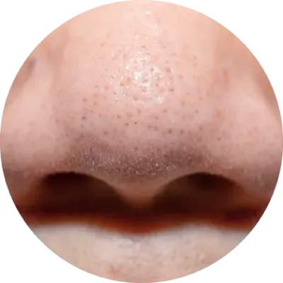 毛穴