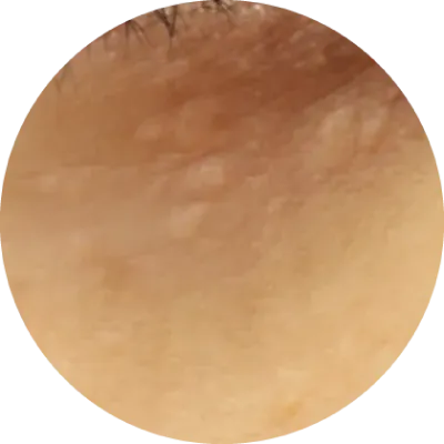 汗管腫