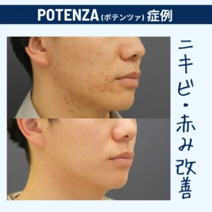 男性の肌悩み　赤み・ニキビ・クレーターにはこれ1台で解消！　POTENZA　ポテンツァ